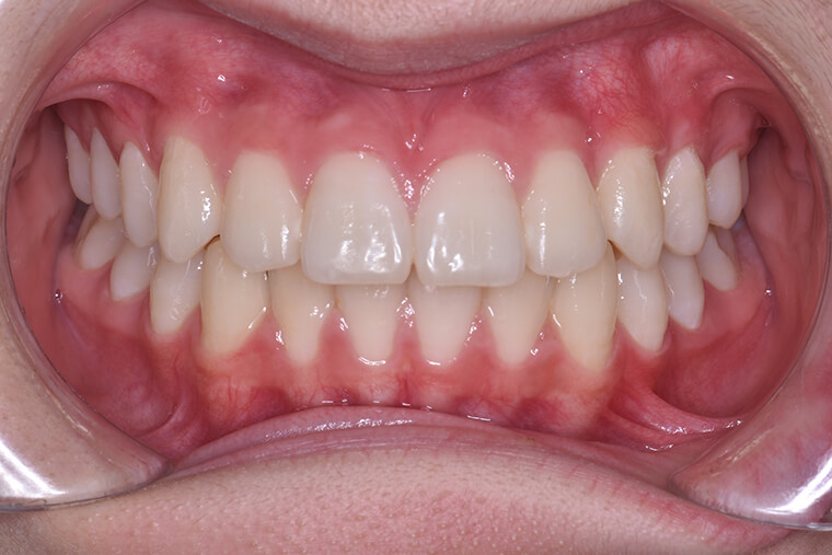 矯正後の歯ならび